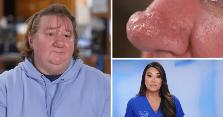 'Dr Pimple Popper' Season 9: Where is Teresa now? Dr Sandra Lee's patient's red face and bumpy nose make her 'feel disgusted'