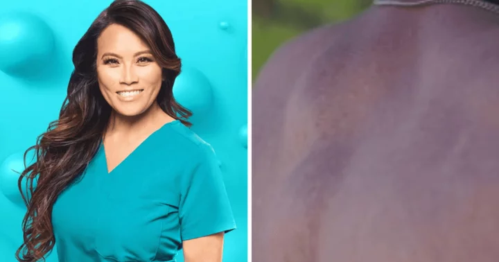 'Dr Pimple Popper': Where is James now? Dr Sandra Lee helps patient by removing painful 'demon bumps' from his spine