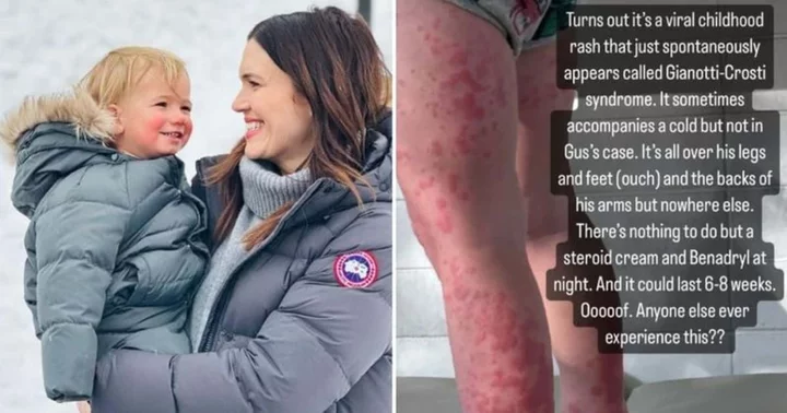 What is Gianotti-Crosti syndrome? Mandy Moore shares her toddler son has a 'crazy rash' due to rare skin condition