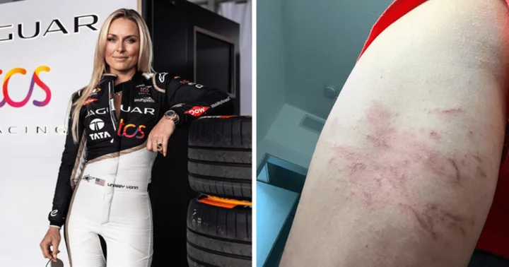 Is Lindsey Vonn OK? Former World Cup alpine ski racer reveals she was stung by a massive jellyfish while surfing